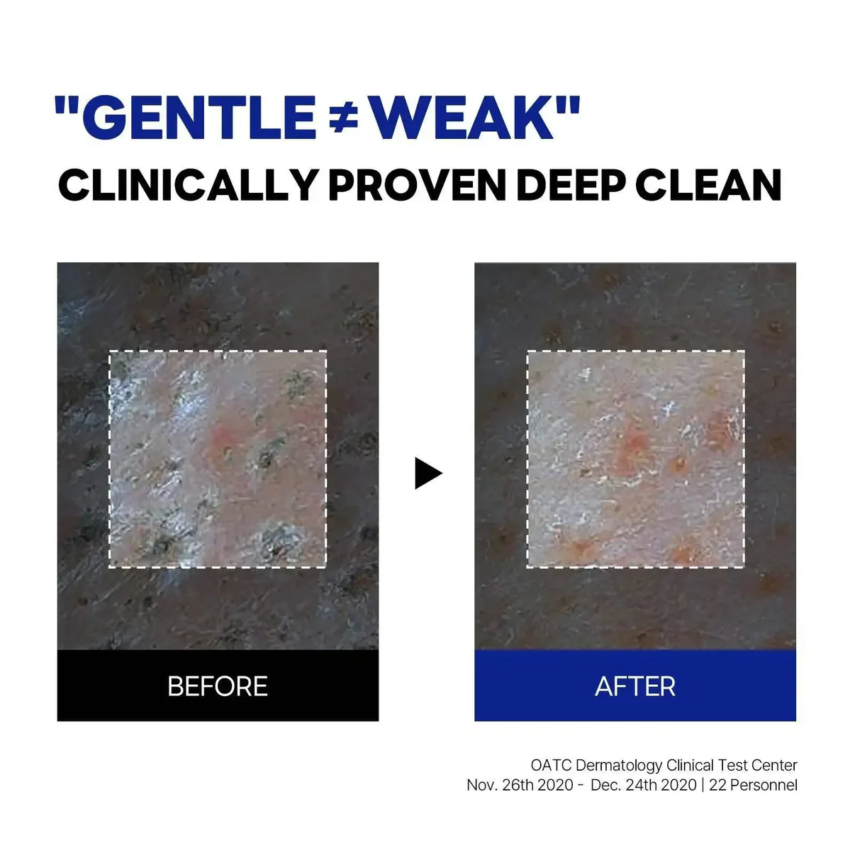 Before and after images showing skin texture improvement with a deep cleansing product, labeled Gentle ≠Weak.